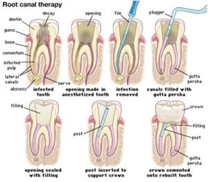Endodontics in Encinitas